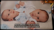 My Story Hassan and Hussein Born Connected baby picture